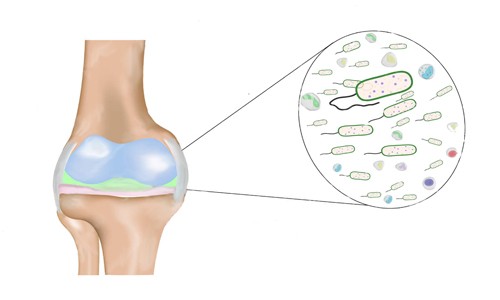 Изображение - Гнойный артрит коленного сустава лечение gnojnogo-vospalenija-kolennogo-sustava