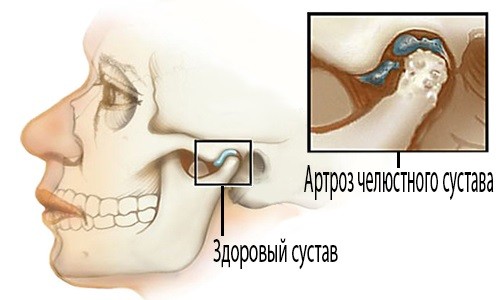 Артроз челюстного сустава
